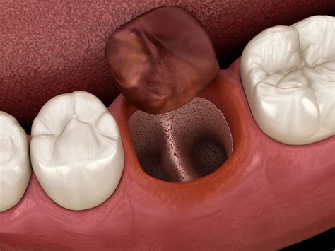 Everything You Need To Know About A Dry Socket Covington Dental