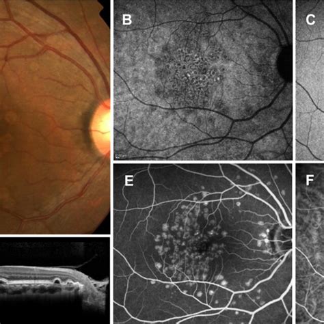 Soft Drusen A Color Fundus Photograph Showing Multiple Drusen Of