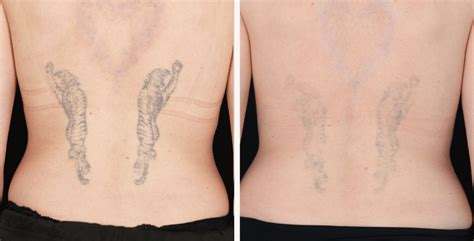 How Much Does Laser Tattoo Removal Cost - VIVA Concept Technology