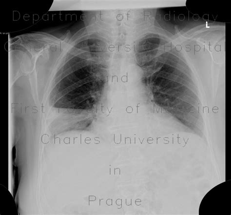 Radiology case: Lobar pneumonia and resolution