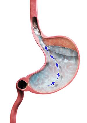 Gastroesophageal Reflux Disease GERD The Woodlands GERD Treatment