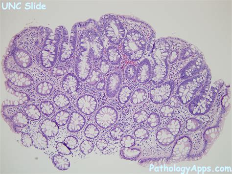 adenomatous polyp large intestine, small intestine histology