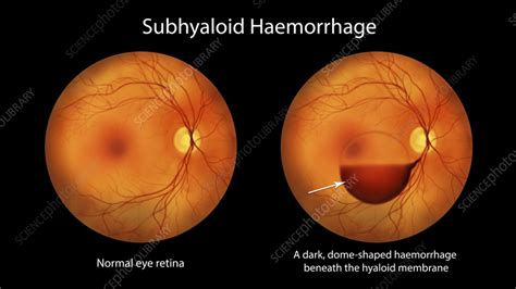 Subhyaloid Haemorrhage On The Retina Illustration Stock Image F