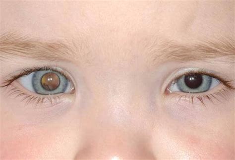 Retinoblastoma