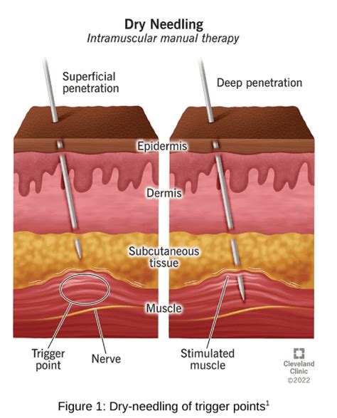 What Is Dry Needling Unbroken Rehab And Athletics