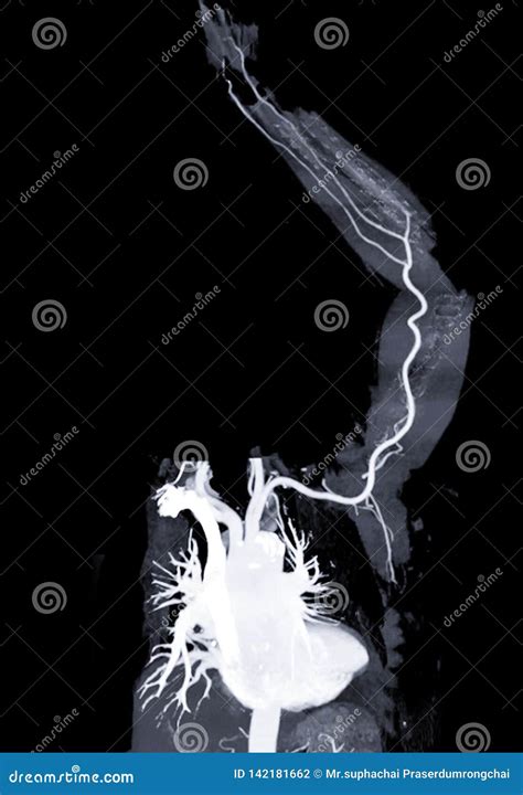 Cta Left Brachial Artery Or Ct Scan Vessel Of Upper Extremity Royalty