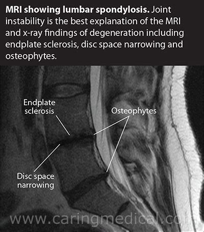 How To Cure Lumbar Spondylosis - Apartmentairline8