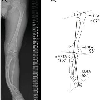 A Preoperative Antero Posterior Long Leg Standing Radiograph B The