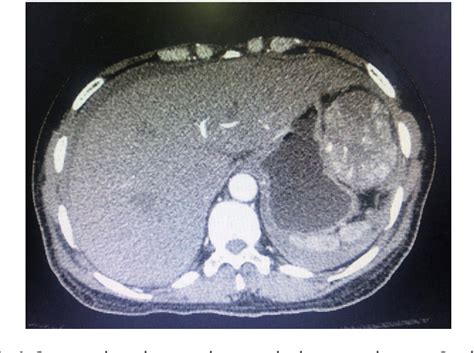 Figure From Emergency Laparoscopic Resection Of Spontaneous Rupture