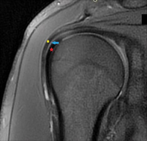 A plane-based approach for the characterization of supraspinatus tendon ...