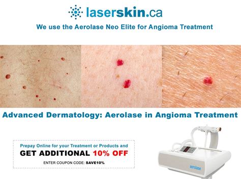 Advanced Dermatology: Aerolase Laser for Angioma Solutions