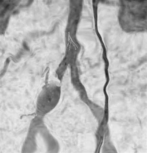 Figure Ivc Thrombosis Image Courtesy S Bhimji Md Statpearls Ncbi