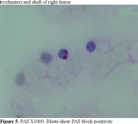 Figure 5 From Osteolytic Bone Lesions A Rare Presentation Of Aml M6