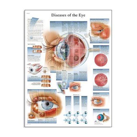 Schéma nemoci lidského oka AJ 50x67 cm anatomické plakáty