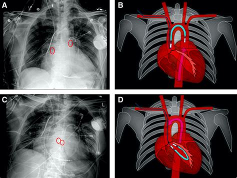 Axillary Intra Aortic Balloon Pump Migration Into The Left Ventricle