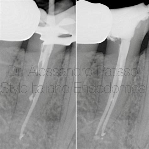 Management Of A Deep Bifurcation In A Mandibular First Premolar With Small Instrument Fractured