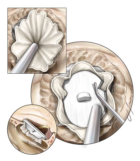 Csf Leak Apparatus