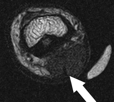 Mri Findings Of Subcutaneous Epidermal Cysts Emphasis On The Presence