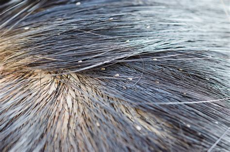 head lice advice kindicare
