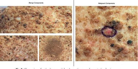 Figure 2 From Genetic Abnormalities In Congenital Melanocytic Nevi And