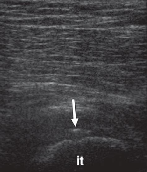 Hamstring Tendon Ultrasound