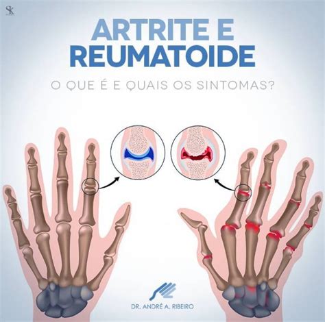 Patologias Dr Andr Ribeiro Ortopedista