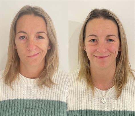 Caci Synergy Delivers Successful Bells Palsy Treatment