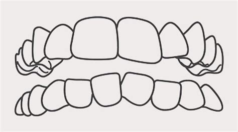 Crowded Crooked Teeth Gentle Touch Orthodontics