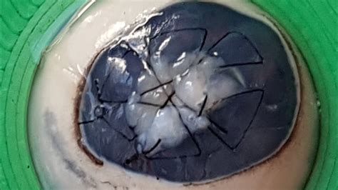 Preparamos un recubrimiento conjuntival en úlcera corneal perforada con