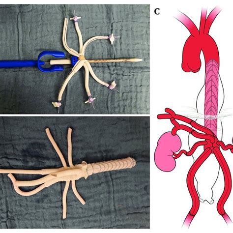 Thoracoflo Graft The Proximal Stent Part Is To Be Deployed Into The