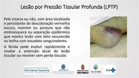 Aula prevenção de lesão por pressão LP PPT