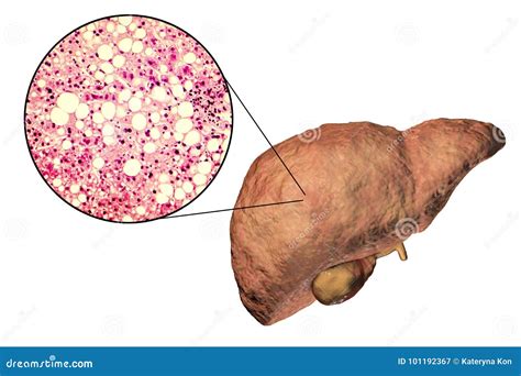 Fatty Liver, Liver Steatosis Stock Illustration - Illustration of biology, disorder: 101192367