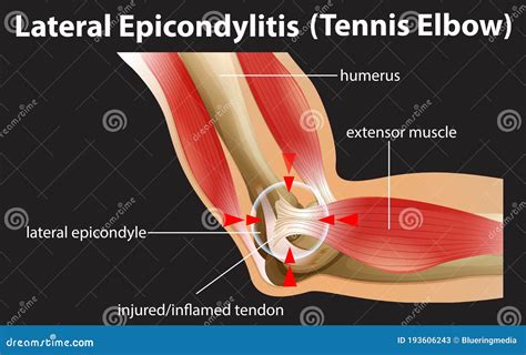 Lateral Epicondylitis Or Tennis Elbow Stock Vector Illustration Of Tendon Biology 193606243