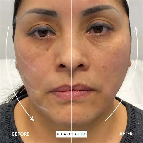 Facefix Threadlift Beautyfix Medspa 212 366 4787