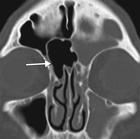 Failed Endoscopic Sinus Surgery Spectrum Of Ct Findings In The Frontal