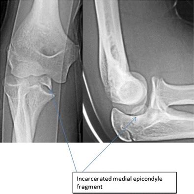 Medial epicondyle fracture that is incarcerated following closed... | Download Scientific Diagram