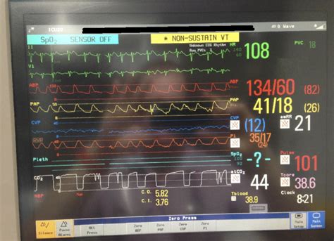 Swan-Ganz catheter Archives - INTENSIVE