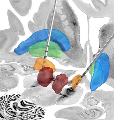 Deep Brain Stimulation For Parkinson S Disease New Algorithm For The