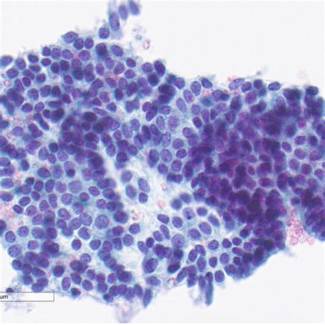 Pre Surgical Fine Needle Aspiration Biopsy Showing Papillary Thyroid