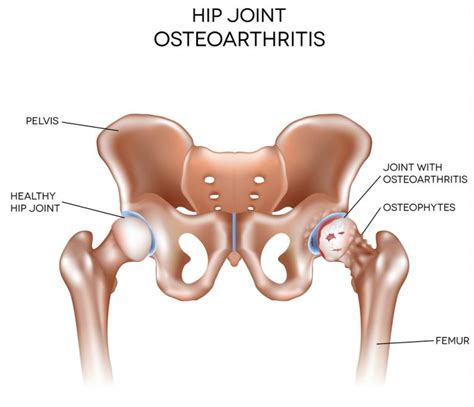 Osteoarthritis Of The Hip How Chiropractic May Help Bradford House Chiropractic Clinic