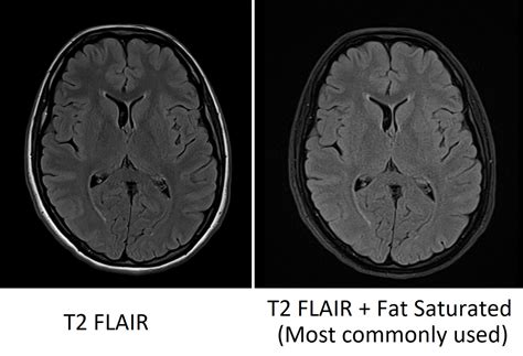 Flair Mri Flair Mri Sequence Physics Image And Pathology Appearance