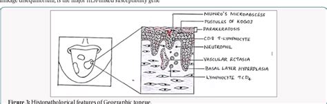 Geographic Tongue Histology