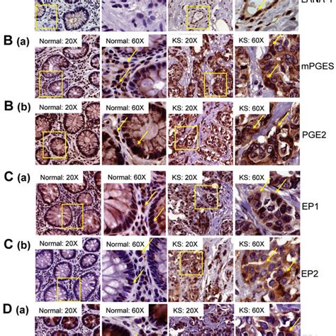 Characterization Of MPGES PGE2 And EP Receptors In KS Lesions A D