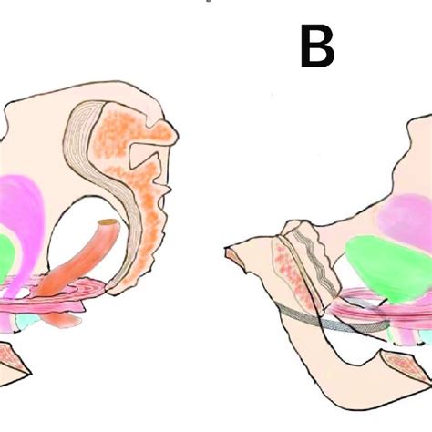 Schematic Diagram Of Operation A Dysuria Caused By Simple Tot