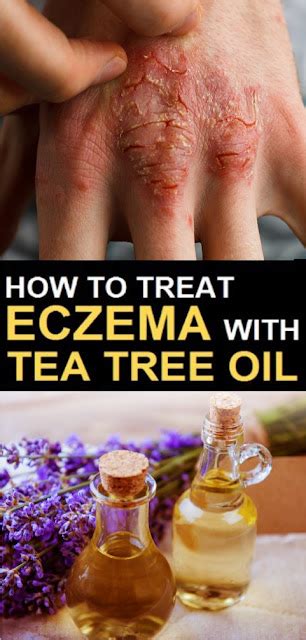 Eczema Cream Recipe – Featuring Lavender & Tea Tree Oil - wellness magazine