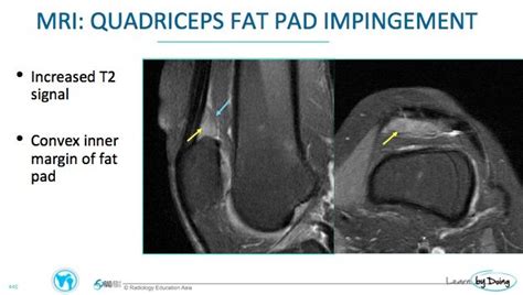 MRI of Fat Pad Impingement Around The Knee - Radedasia