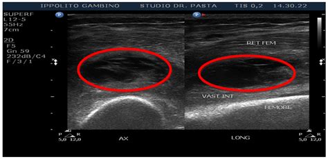 Diagnostic Imaging In Muscle Injury Intechopen