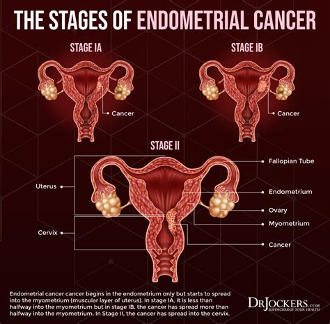 Stages Of Uterine Cancer