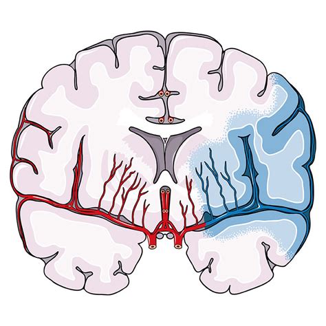 Ischemic Stroke Vector Scientific Illustration