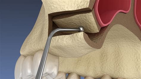 Sinus Lift Montville Oral Surgery